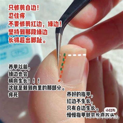 拔指甲|拔甲术后恢复指南：时间、注意事项与促进方法